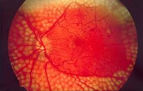 RETINOPATIA DIABETICA APOS TRATAMENTO COM LASER