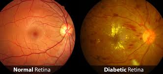 RETINOPATIA DIABETICA ANTES DO TRATAMENTO